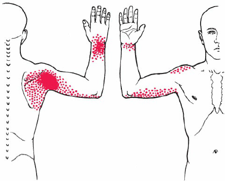 Trigger points subscapulaire