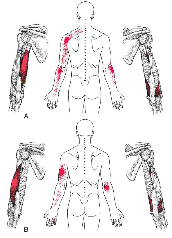 Trigger points du triceps brachial